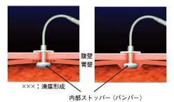 バンパー埋没症候群