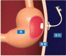 胃ろう（PEG）とは…