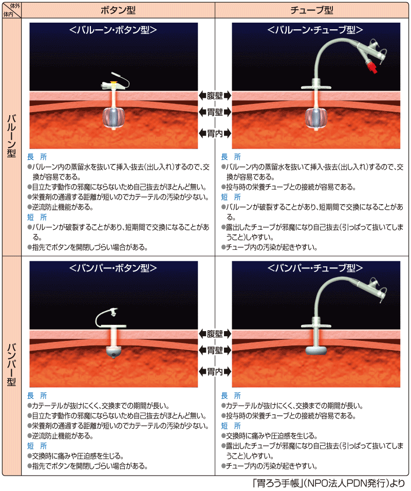 胃ろうカテーテル４種の比較（胃ろう手帳より）