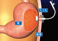 胃ろう入門