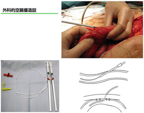 図２　外科的空腸瘻造設