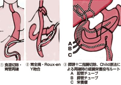 図1 腹部手術時の空腸瘻造設の方法