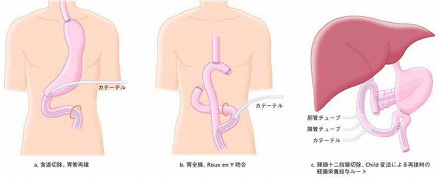 図2　腹部手術における空腸瘻造設法