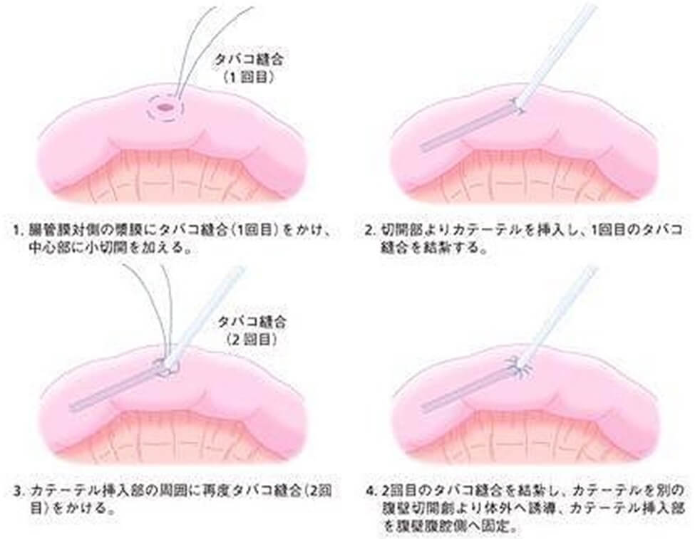 タバコ 縫合