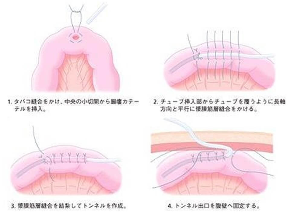 縫合 タバコ