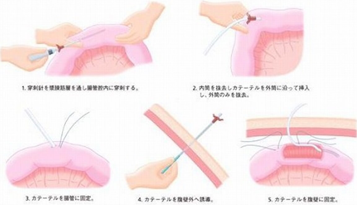 タバコ 縫合