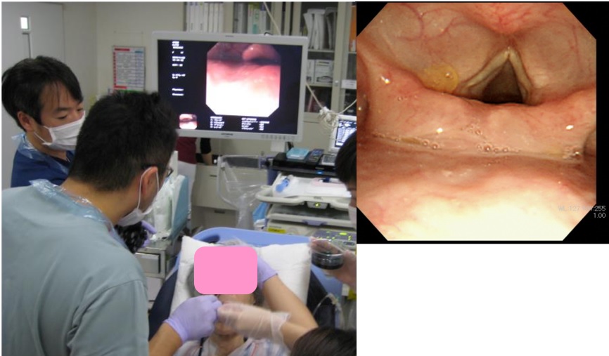 図１ 嚥下内視鏡の様子