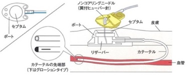 図３  CVポートの構造と専用の穿刺針：ヒューバー針