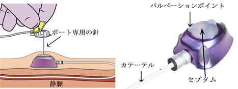 図４  パワーポートのパルペーションポイント（３点突起）