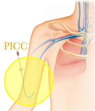 図２　PICC の模式図