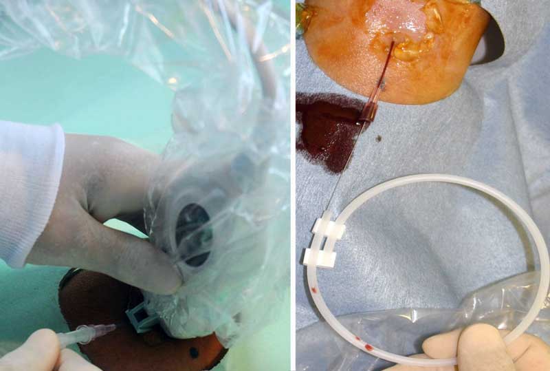 図5 エコーガイド下での上腕の静脈(尺側皮静脈または上腕静脈)の穿刺