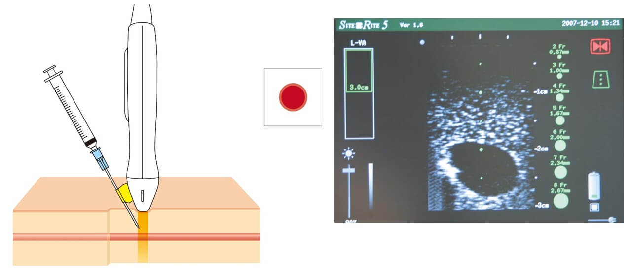 静脈のエコーによる断面像