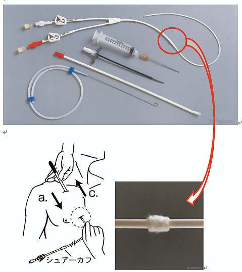 図２　ブロッビアック／ヒックマン　カテーテル