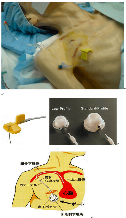 図３　完全皮下埋め込み式ポート・カテーテル　その1