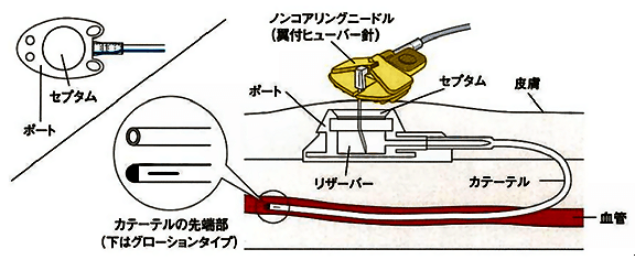 Cv ポート 看護