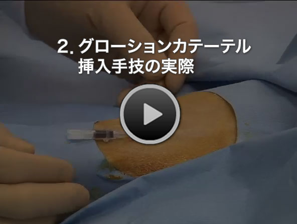 2.グローションカテーテル挿入手技の実際-クリックで再生