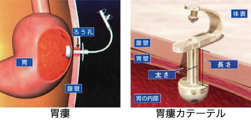 図１．胃瘻とカテーテル