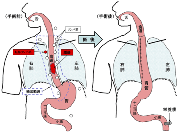 図２ 食道癌手術シェーマ