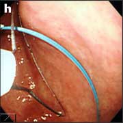 あらかじめ内視鏡にてスネアワイヤーを胃内で展開しておき、ループワイヤーを把持する1