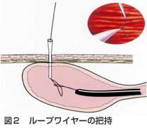 ループワイヤーの把持