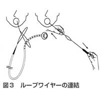 ループワイヤーの連結