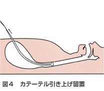 カテーテル引き上げ留置