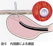 内視鏡による確認