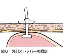 外部ストッパーを固定する