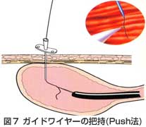 ガイドワイヤーの把持（Push法）