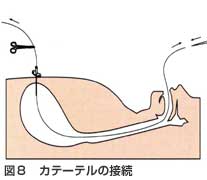 カテーテルの接続