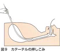 カテーテルの押し込み