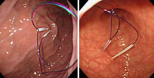 図５　胃内で半月形にループを拡張し、他方のナイロン糸を把持