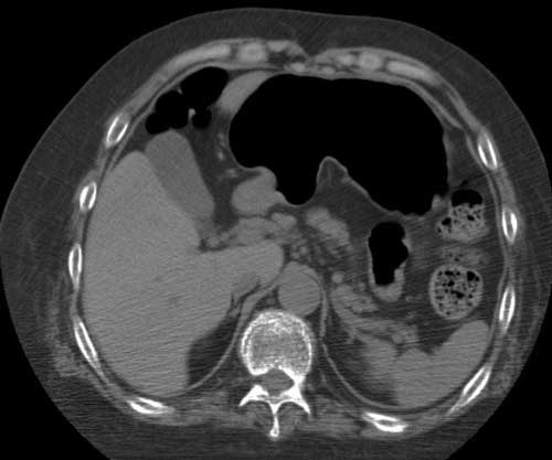 腹部のCT 美品 腹部CT検査：小腸拡張像，腹水貯留を認めた．また，臍部直下に盲