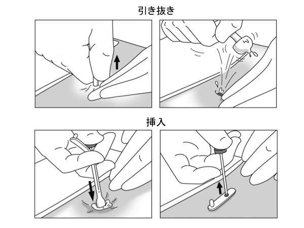 図６　カテーテル非切断法