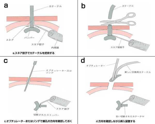 図７　カテーテル切断法