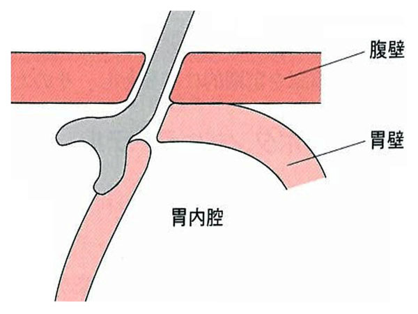 図９　腹腔内誤留置の模式図