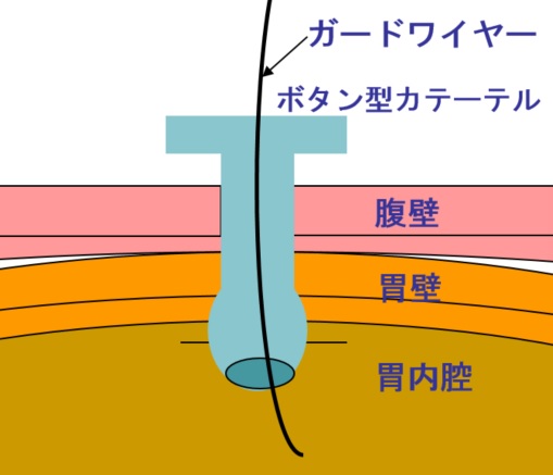 図９　ガイドワイヤーを用いたカテーテル交換