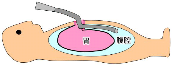 図１　胃瘻カテーテル挿入後の腹腔内誤挿入