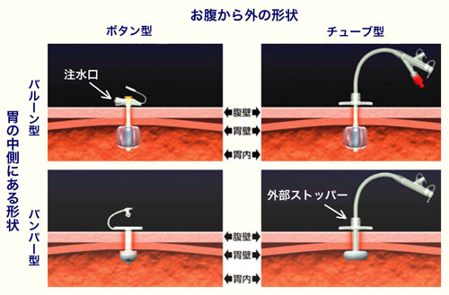 図１　カテーテルの種類