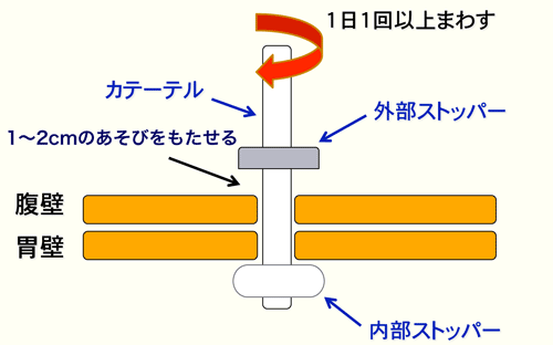 図２　腹壁と外部ストッパーの間に1～2cmのあそびをもたせる