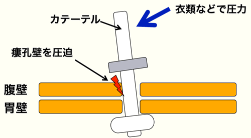 図３　チューブがなるべく皮膚面に対して垂直に立つようにし、瘻孔に負担（圧力）をかけないようにする