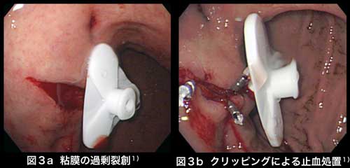 カテーテル周囲粘膜が大きく裂けてしまった場合(図３a)、後出血の危険性を考慮して、トロンビン散布やクリッピングなどの止血処置(図３b)を行うことが望ましい。