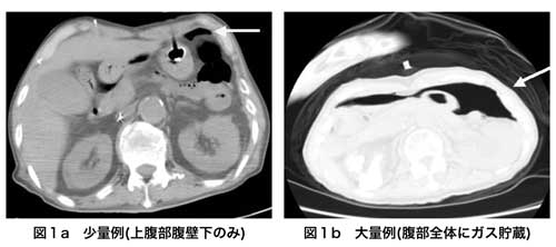 図１　PEG後の気腹症例