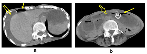 図３ PEG後早期に合併した汎発性腹膜炎症例 