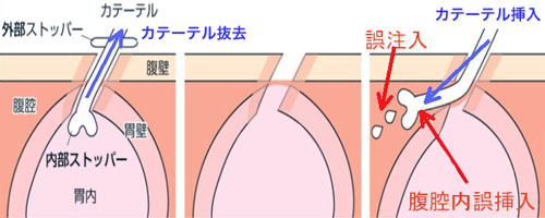 図１　腹腔内誤挿入と誤注入