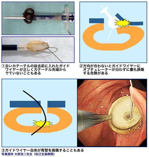 図２　腹腔内誤注入による医療事故は社会的問題になっている