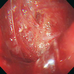 図３　胃穿孔症例