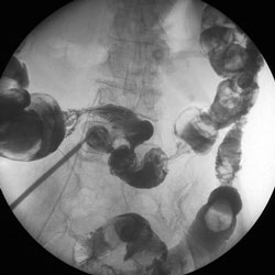 図４　交換後の結腸皮膚瘻