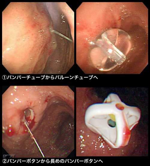 図８　瘻孔確保⇒直ちに再留置