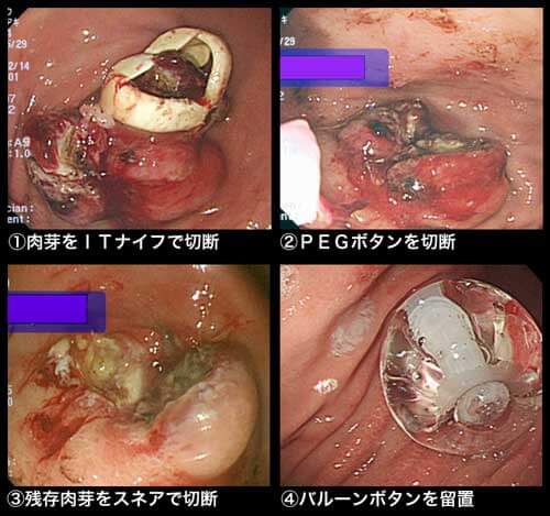 図９　造設3年後に、胃瘻カテーテルが抜去出来ず交換不能となった。前回から4ヵ月と20日ぶりの交換であり、その間胃瘻カテーテルの回転は行っていなかった。